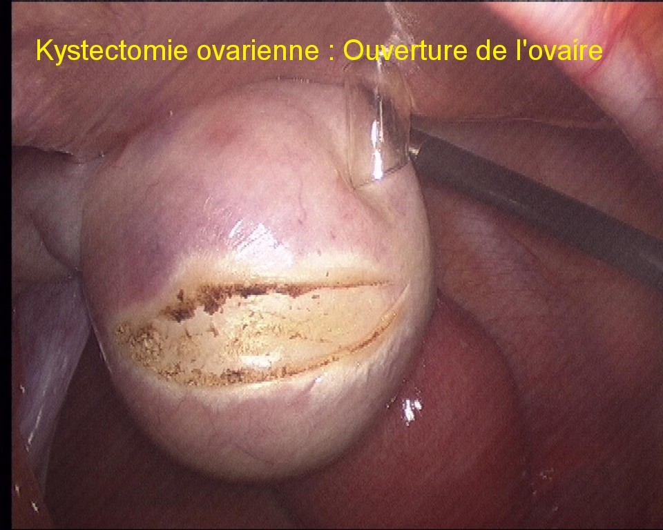 gynecolyon : chirurgie-des-ovaires-et-des-trompes-par-coelioscopie