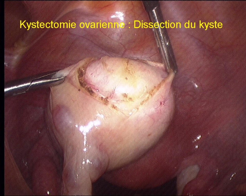 gynecolyon : chirurgie-des-ovaires-et-des-trompes-par-coelioscopie