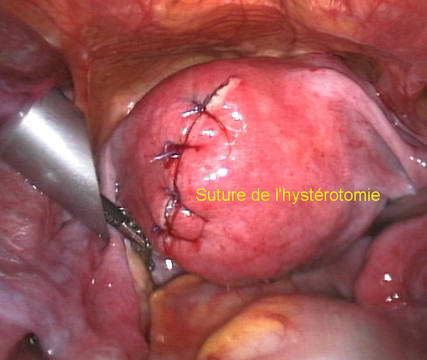 gynecolyon : ablation-de-fibromes-uterins-myomectomie-par-coelioscopie