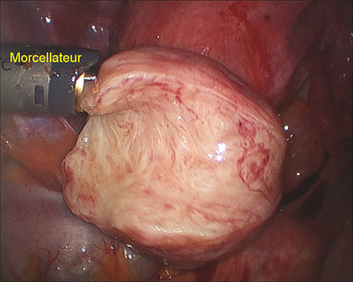 gynecolyon : ablation-de-fibromes-uterins-myomectomie-par-coelioscopie